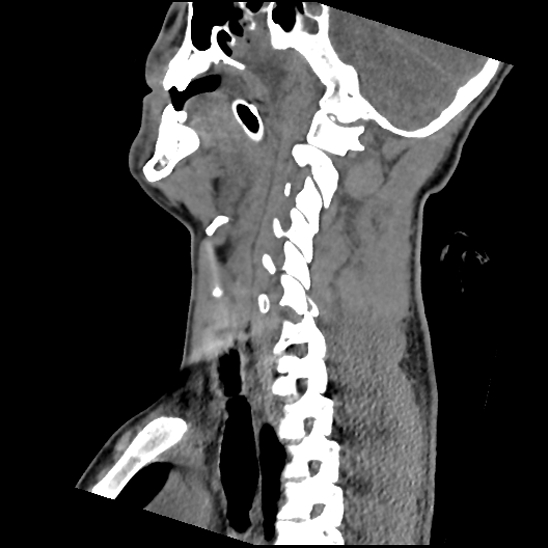 File:Atlanto-occipital dissociation (Traynelis type 1), C2 teardrop fracture, C6-7 facet joint dislocation (Radiopaedia 87655-104061 D 38).jpg