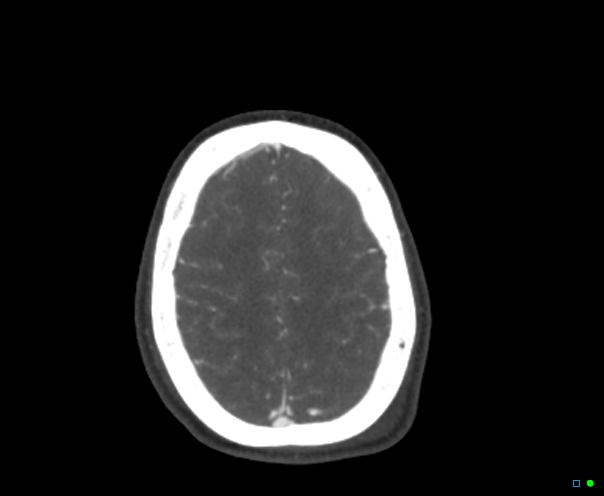 Atlanto-occipital dissociation - Traynelis type 1 (Radiopaedia 87570-103949 A 89).jpg