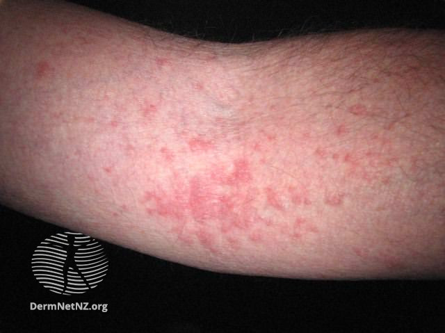 File:Atopic dermatitis (DermNet NZ dermatitis-flexural-eczema20).jpg