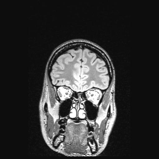 Atretic encephalocoele with inferior vermis hypoplasia (Radiopaedia 30443-31108 Coronal FLAIR 144).jpg