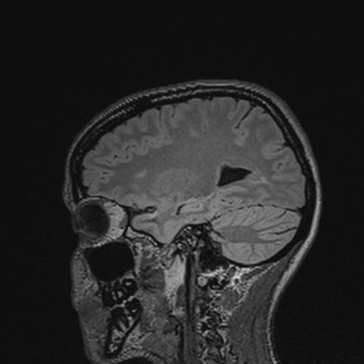Atretic encephalocoele with inferior vermis hypoplasia (Radiopaedia 30443-31108 Sagittal FLAIR 108).jpg