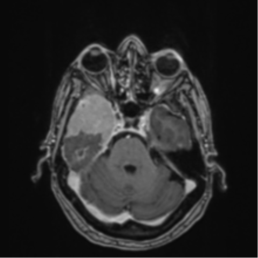 Atypical meningioma (WHO Grade II) (Radiopaedia 54742-60979 Axial T1 C+ 17).png