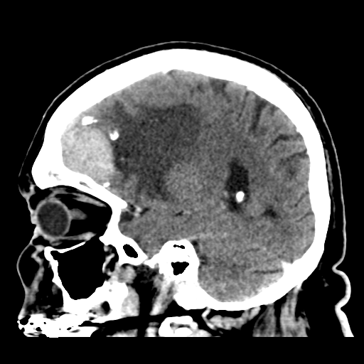 Atypical meningioma (WHO grade II) with brain invasion (Radiopaedia 57767-64728 Sagittal C+ 17).png
