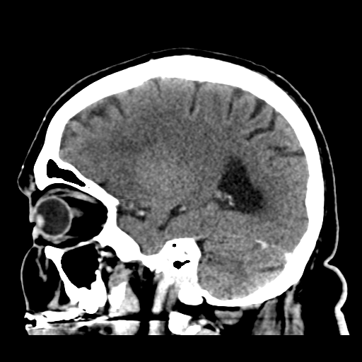 Atypical meningioma (WHO grade II) with brain invasion (Radiopaedia 57767-64728 Sagittal C+ 36).png