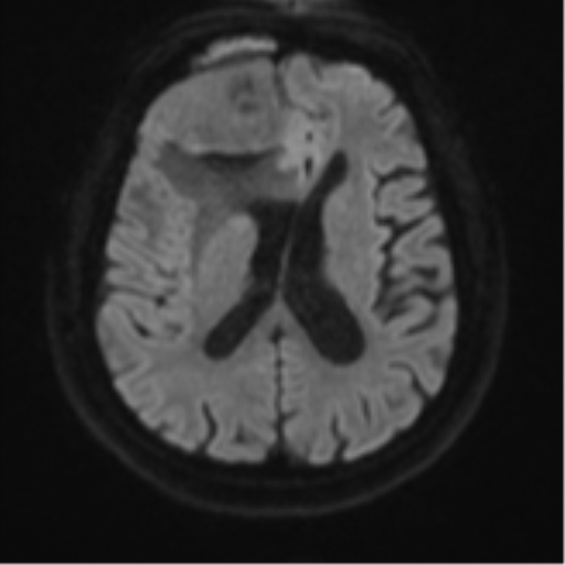 Atypical meningioma (WHO grade II) with brain invasion (Radiopaedia 57767-64729 Axial DWI 47).png