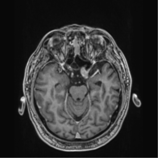 File:Atypical meningioma (WHO grade II) with brain invasion (Radiopaedia 57767-64729 Axial T1 C+ 17).png