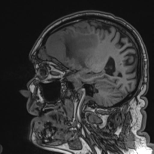 Atypical meningioma (WHO grade II) with brain invasion (Radiopaedia 57767-64729 Sagittal T1 45).png
