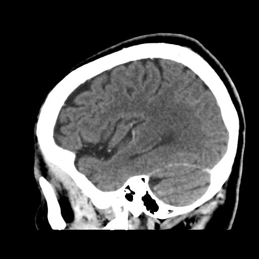 File:Atypical meningioma (WHO grade II) with osseous invasion (Radiopaedia 53654-59715 G 41).png