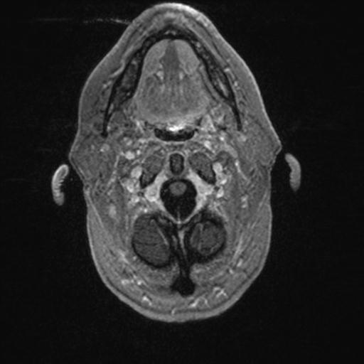 Atypical meningioma (grade II) - en plaque (Radiopaedia 29633-30147 Axial T1 C+ 17).jpg
