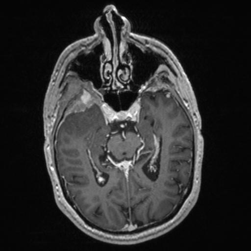 Atypical meningioma (grade II) - en plaque (Radiopaedia 29633-30147 Axial T1 C+ 80).jpg
