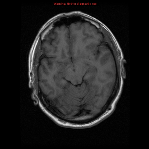 File:Atypical meningioma - grade II (Radiopaedia 13303-13305 Axial T1 9).jpg
