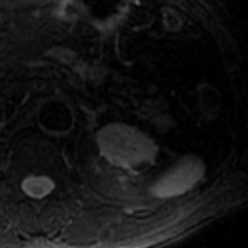 File:Atypical renal cyst on MRI (Radiopaedia 17349-17046 Axial T2 fat sat 4).jpg