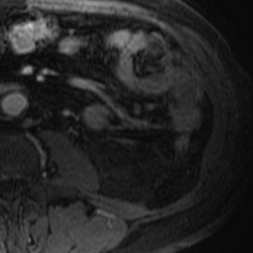 File:Atypical renal cyst on MRI (Radiopaedia 17349-17046 D 32).jpg
