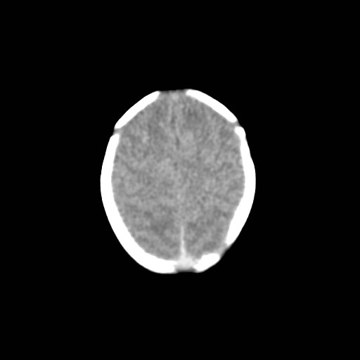 File:Atypical teratoid rhabdoid tumor (prenatal US and neonatal MRI) (Radiopaedia 59091-66387 Axial non-contrast 33).jpg
