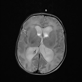 File:Atypical teratoid rhabdoid tumor (prenatal US and neonatal MRI) (Radiopaedia 59091-66388 Axial T2 18).jpg