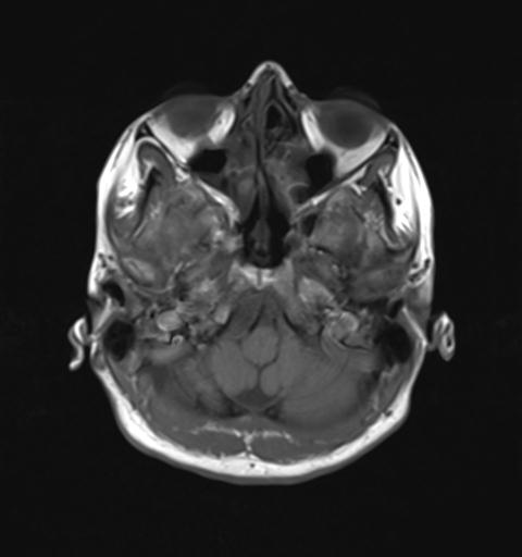 File:Autoimmune limbic encephalitis (Radiopaedia 30363-31005 Axial T1 6).jpg