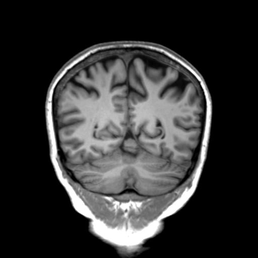 Autoimmune limbic encephalitis (Radiopaedia 30363-31005 Coronal T1 17).jpg
