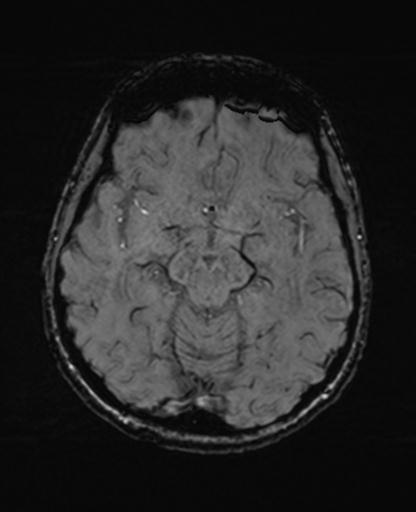 Autoimmune limbic encephalitis (Radiopaedia 30363-31005 SWI 32).jpg