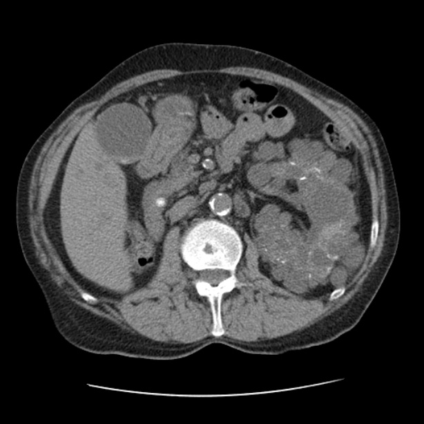 Autosomal dominant polycystic kidney disease (Radiopaedia 27851-28094 Axial non-contrast 69).jpg