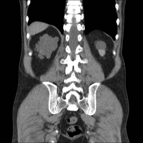 Autosomal dominant polycystic kidney disease (Radiopaedia 36539-38101 C 54).jpg