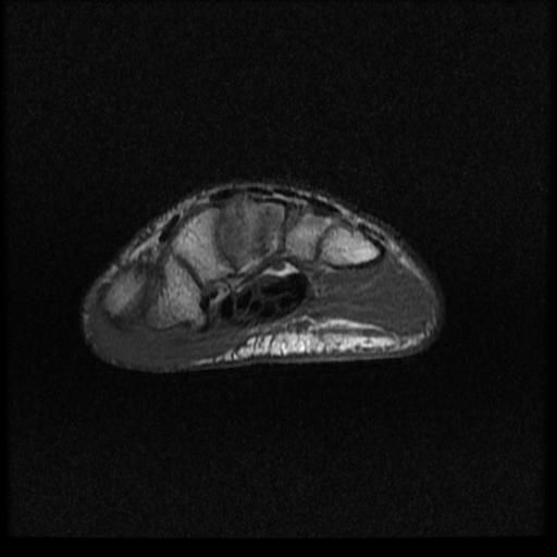 File:Avascular necrosis - scaphoid non-union (Radiopaedia 63457-72065 Axial T1 4).jpg