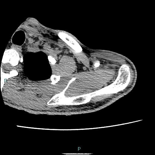Avascular necrosis after fracture dislocations of the proximal humerus (Radiopaedia 88078-104653 D 20).jpg