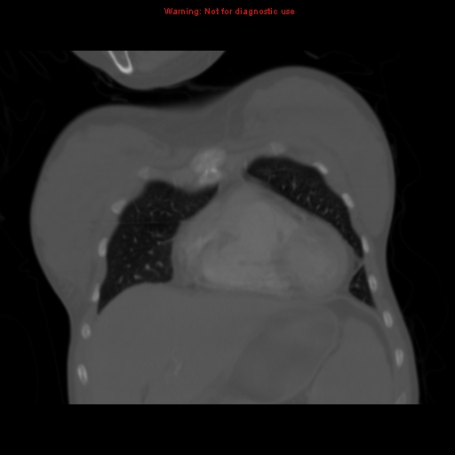 Avascular necrosis in sickle cell disease (Radiopaedia 17448-17152 Coronal bone window 28).jpg