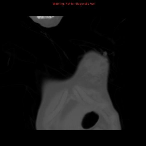 File:Avascular necrosis in sickle cell disease (Radiopaedia 17448-17152 Coronal bone window 3).jpg