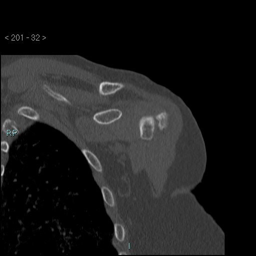 Avascular necrosis of the shoulder - Cruess stage I (Radiopaedia 77674-89887 Coronal bone window 31).jpg