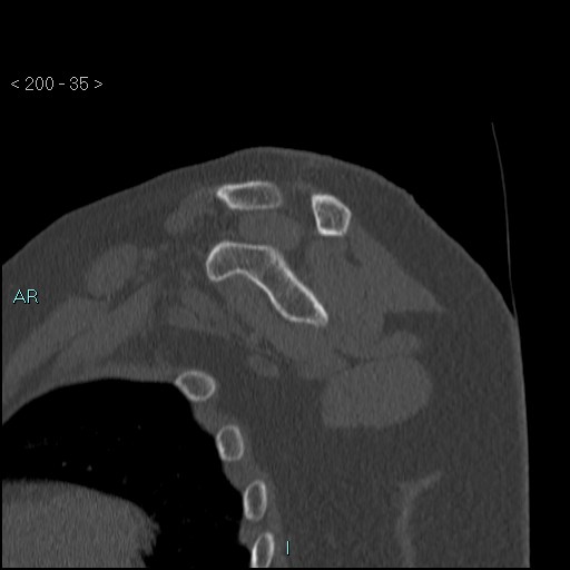 File:Avascular necrosis of the shoulder - Cruess stage I (Radiopaedia 77674-89887 Sagittal bone window 34).jpg
