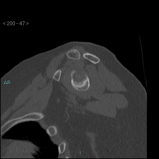 Avascular necrosis of the shoulder - Cruess stage I (Radiopaedia 77674-89887 Sagittal bone window 46).jpg