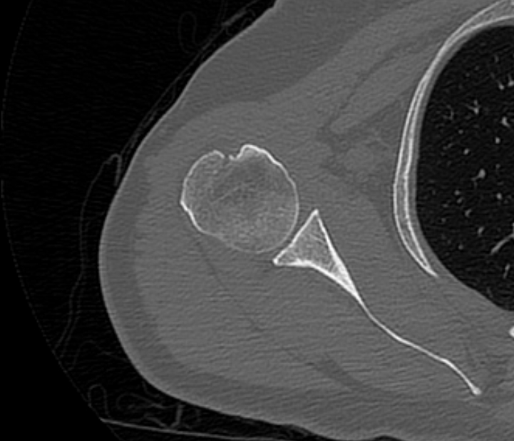 Avulsion fracture - greater tuberosity of humerus (Radiopaedia 71216-81514 Axial bone window 42).jpg