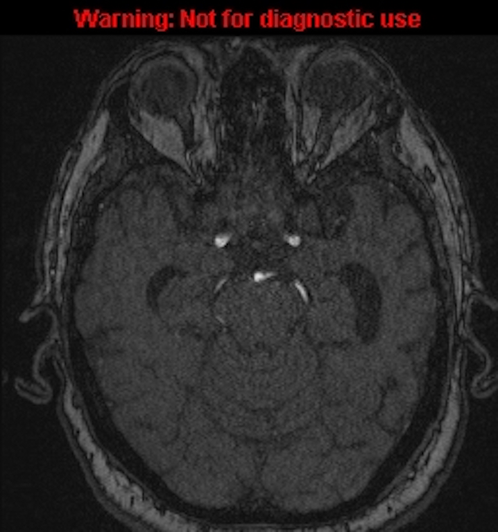 Azygos anterior cerebral artery (Radiopaedia 59325-66677 Axial MRA 60).jpg