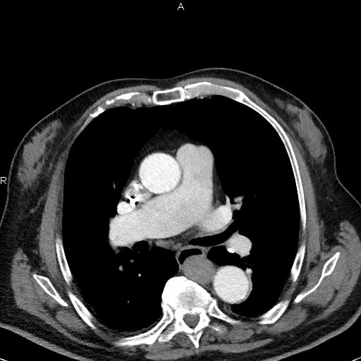File:Azygos continuation of the inferior vena cava (Radiopaedia 18537-18404 C+ arterial phase 28).jpg