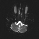 Balo concentric sclerosis (Radiopaedia 50458-55940 Axial DWI 19).jpg