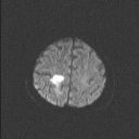 Balo concentric sclerosis (Radiopaedia 50458-55940 Axial DWI 51).jpg