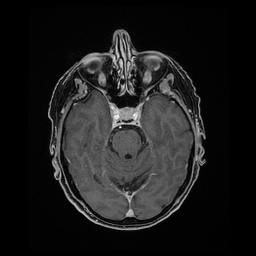Balo concentric sclerosis (Radiopaedia 53875-59982 Axial LAVA C+ 91).jpg