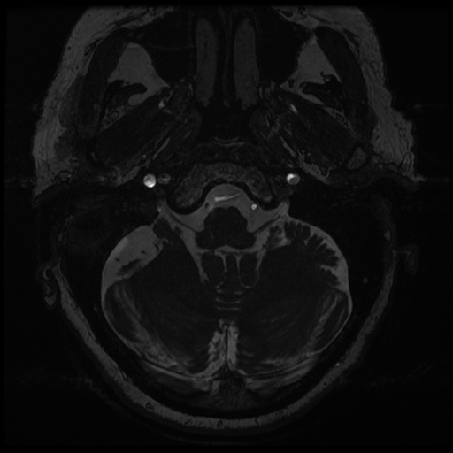 File:Balo concentric sclerosis (Radiopaedia 53875-59982 Axial T2 FIESTA 12).jpg