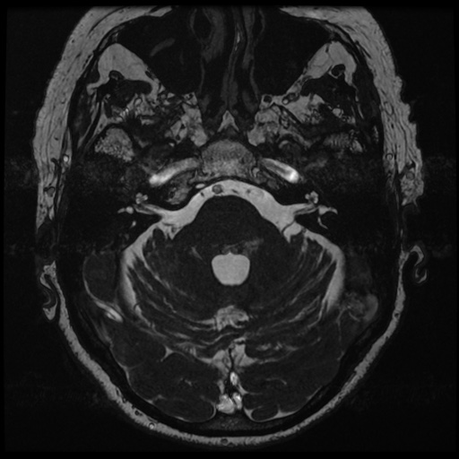 File:Balo concentric sclerosis (Radiopaedia 53875-59982 Axial T2 FIESTA 39).jpg