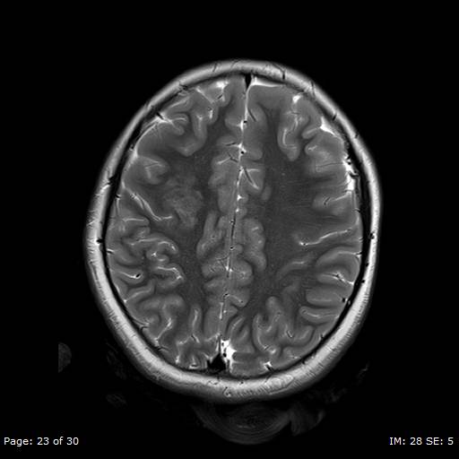 File:Balo concentric sclerosis (Radiopaedia 61637-69636 Axial T2 23).jpg