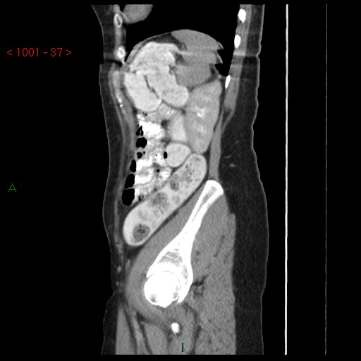 File:Bartholin gland cyst (Radiopaedia 54904-61181 Sagittal C+ delayed 37).jpg