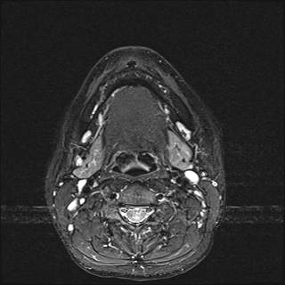 File:Basal cell carcinoma - nasal region (Radiopaedia 70292-80365 Axial STIR 29).jpg