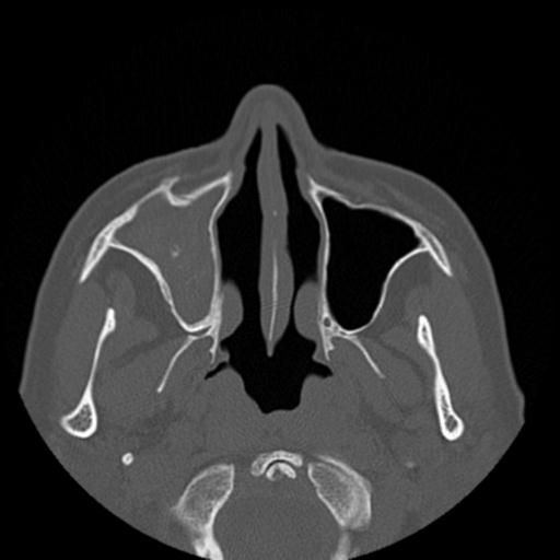 File:Base of skull chondrosarcoma (Radiopaedia 30410-31071 Axial bone window 11).jpg