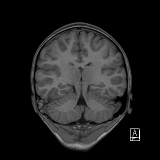 Base of skull rhabdomyosarcoma (Radiopaedia 32196-33142 Coronal T1 31).jpg