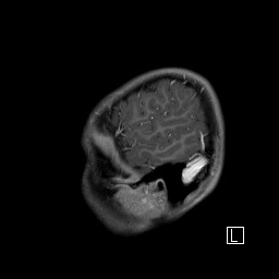 Base of skull rhabdomyosarcoma (Radiopaedia 32196-33142 J 54).jpg