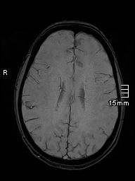 File:Basilar artery perforator aneurysm (Radiopaedia 82455-99523 Axial SWI 43).jpg