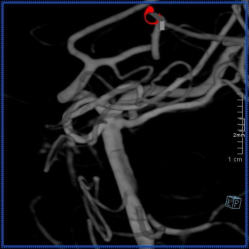 Basilar artery perforator aneurysm (Radiopaedia 82455-99524 3D Left VA 9).jpg