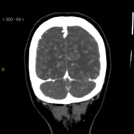 File:Basilar artery thrombosis (Radiopaedia 16260-15944 B 59).jpg