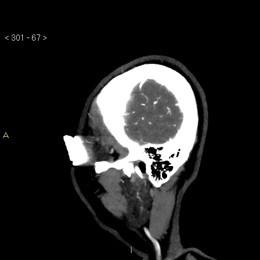 Basilar artery thrombosis (Radiopaedia 16260-15944 C 61).jpg