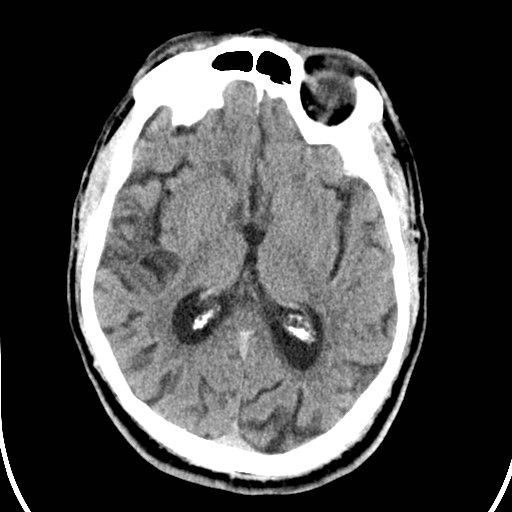 File:Basilar artery thrombosis (Radiopaedia 26986-27162 Axial non-contrast 17).jpg